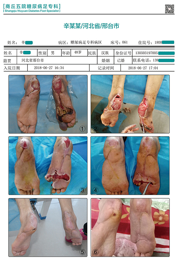 袁敏琴：为什么糖尿病患者的皮肤容易感染出现糖尿病足？