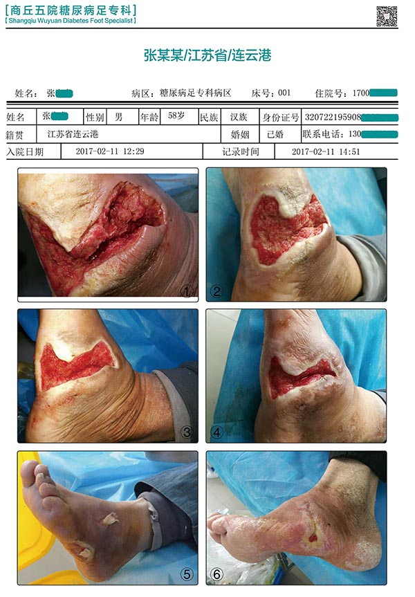 袁敏琴浅谈治疗糖尿病足用哪些抗生素才能有效控制感染问题