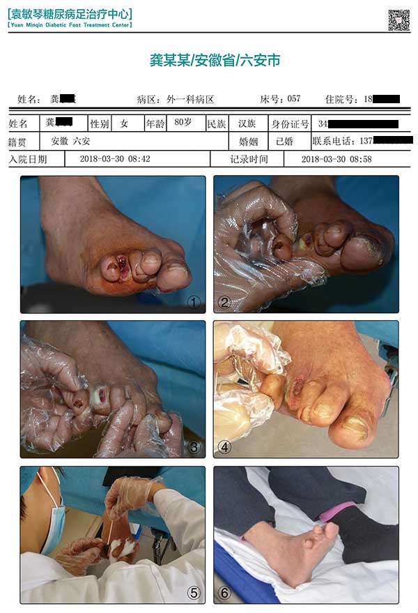 袁敏琴糖足中心：年纪大的糖尿病足患者怎么治疗