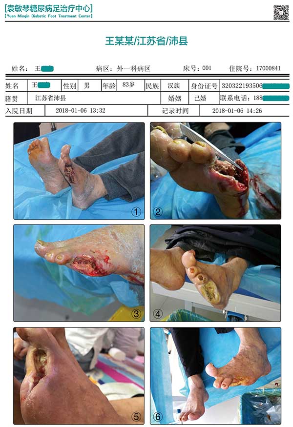 袁敏琴糖足中心：年纪大的糖尿病足患者怎么治疗？