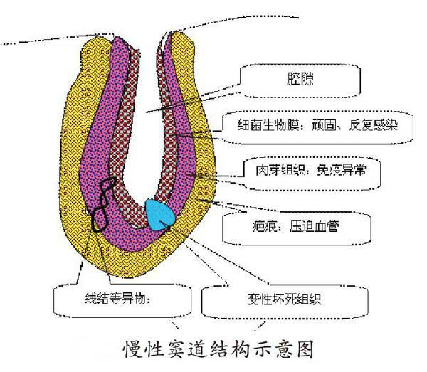 糖尿病人脚上有一个小洞一直往外流脓液怎么治疗