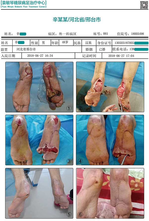 糖尿病人出现烂脚一直治不好，中西医结合真的能保守治疗吗？