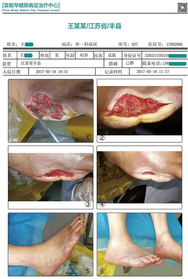 典型糖尿病足案例告诉大家为什么糖尿病足总治不好