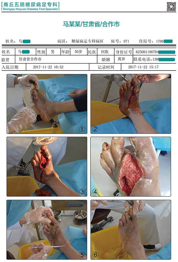 糖尿病患者出现腿脚麻木无力要去医院检查吗