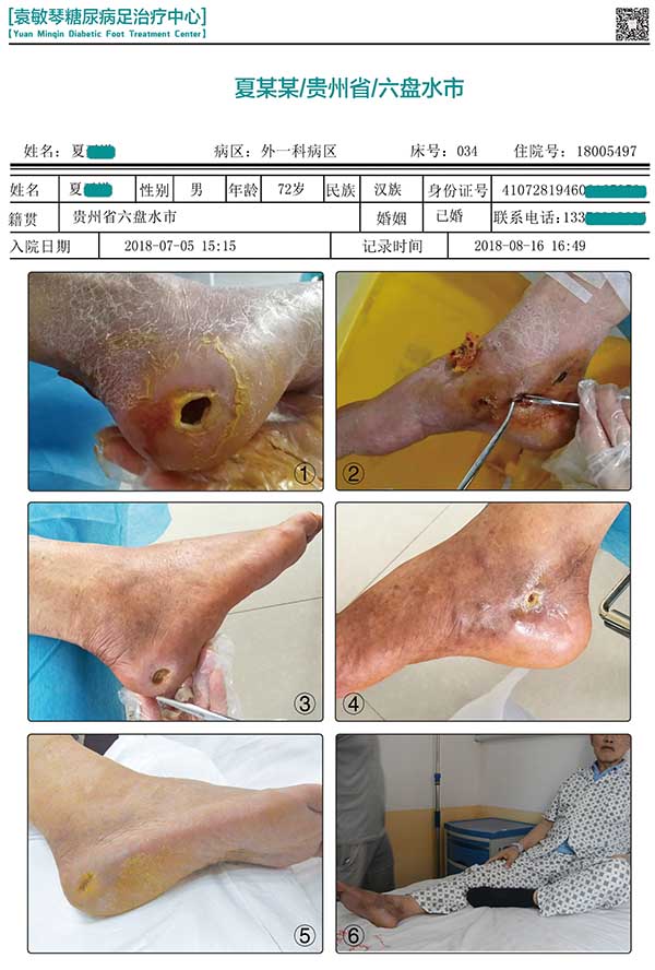 糖尿病患者出现腿脚麻木无力要去医院检查吗