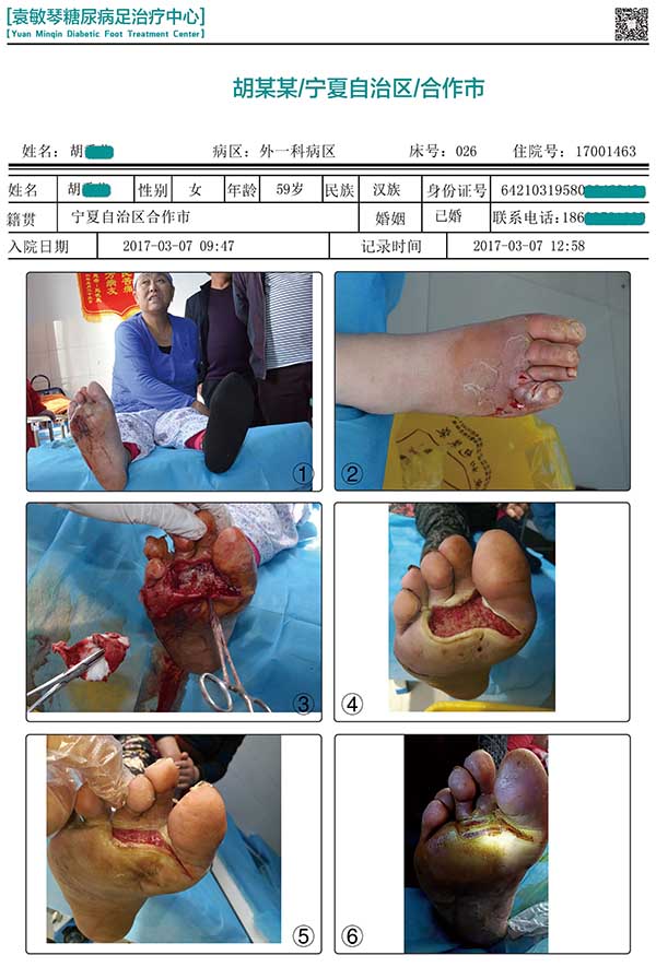 商丘市第五人民医院不截肢保守治疗糖尿病足的案例和图片