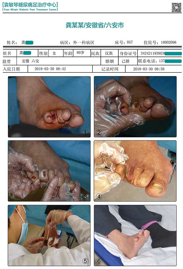 商丘市第五人民医院不截肢保守治疗糖尿病足的案例和图片