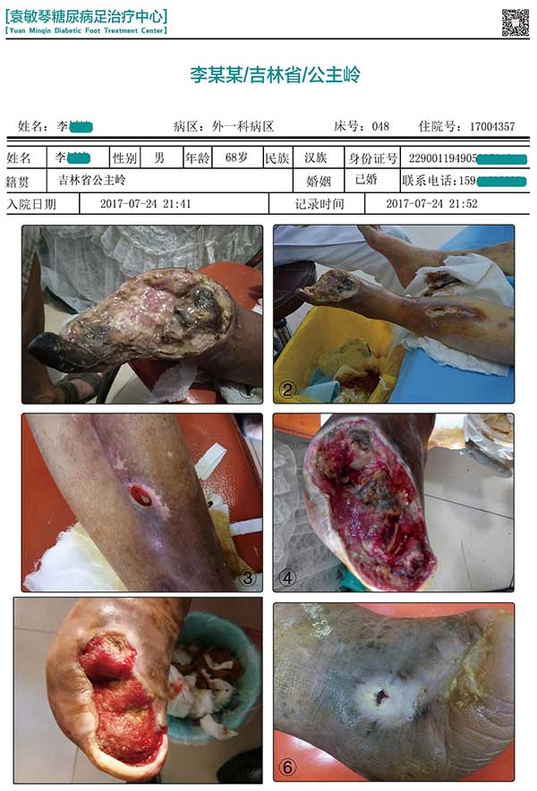 糖尿病足严重的话是否需要截肢?看一个内分泌科医生是怎么回答的！ 图 只是一个脚趾感染和坏疽，医生就建议截肢，这是为病人的健康着想吗