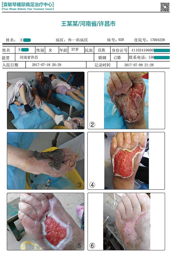 袁敏琴：糖尿病足患者是不是截肢了就能好了?